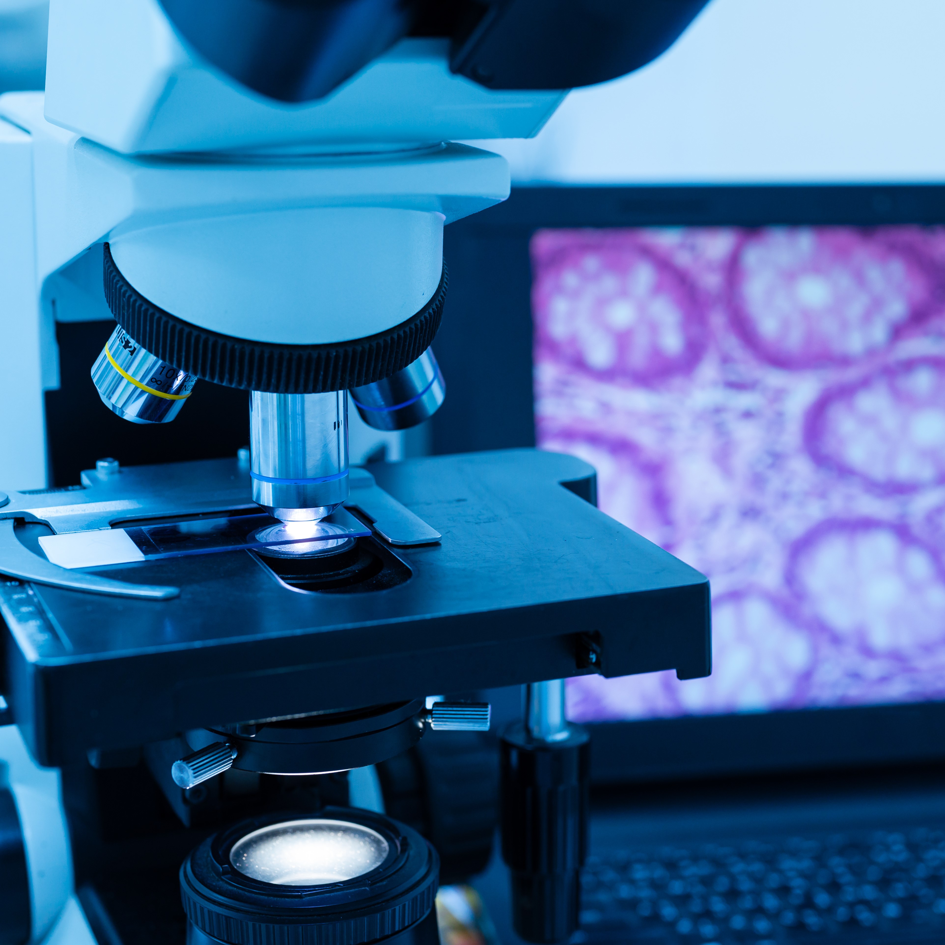 Modern microscope and human tissue section slide with computer monitor show glandular image.Medical patholology and cytologytechnology concept.Selective focus.